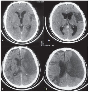 Exames de imagem ajudam a diagnosticar a hemorragia intracriana e a extensão da lesão no cérebro